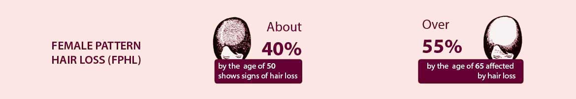 female-pattern-hair-loss